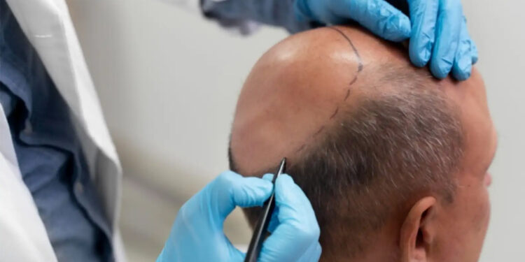 முடி மாற்று அறுவைச் சிகிச்சை செய்த பல் மருத்தவர்கள் மீது புகார் : பரிதாபமாக உயிரிழந்த இருவர் !