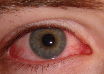 மழைக்காலத்தில் பரவும் ‘மெட்ராஸ் ஐ’ அறிகுறிகள் தடுப்பது எப்படி ?