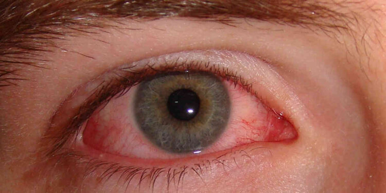 மழைக்காலத்தில் பரவும் ‘மெட்ராஸ் ஐ’ அறிகுறிகள் தடுப்பது எப்படி ?