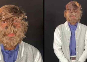 முகத்தில் அதிக முடி கொண்ட இந்திய சிறுவன் – கின்னஸ் சாதனையில் இடம்பிடித்தார் !