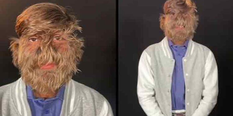 முகத்தில் அதிக முடி கொண்ட இந்திய சிறுவன் – கின்னஸ் சாதனையில் இடம்பிடித்தார் !